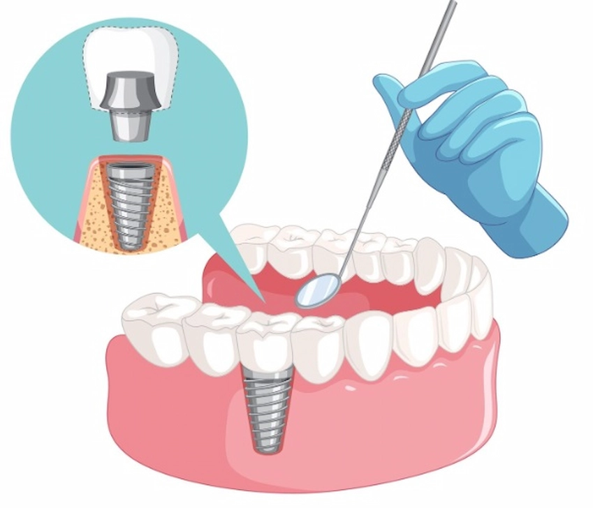dental implant procedure