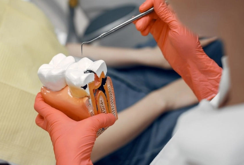 quanto tempo richiede un riempimento dentale