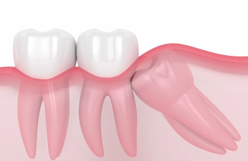 wisdom teeth grow