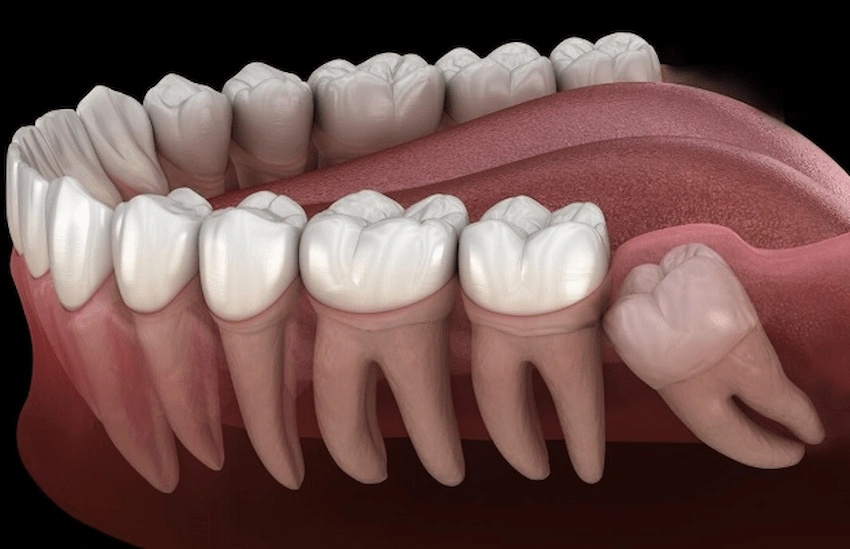 wisdom teeth surgery