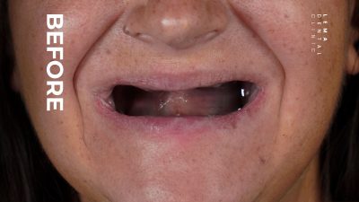 zygomatic implants before after 1