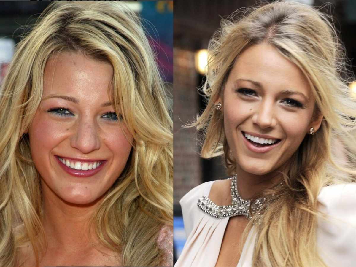 blake lively teeth before after