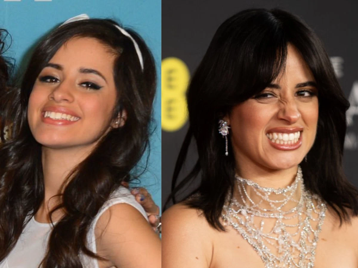 camila cabello teeth before after