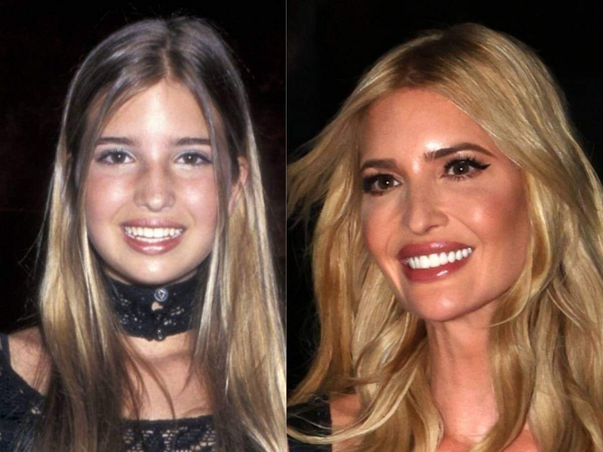 ivanka trump teeth before after