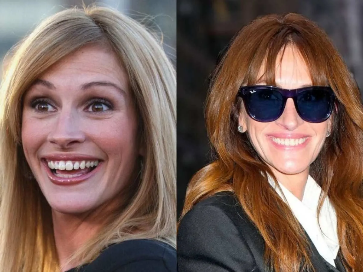 julia roberts teeth before after
