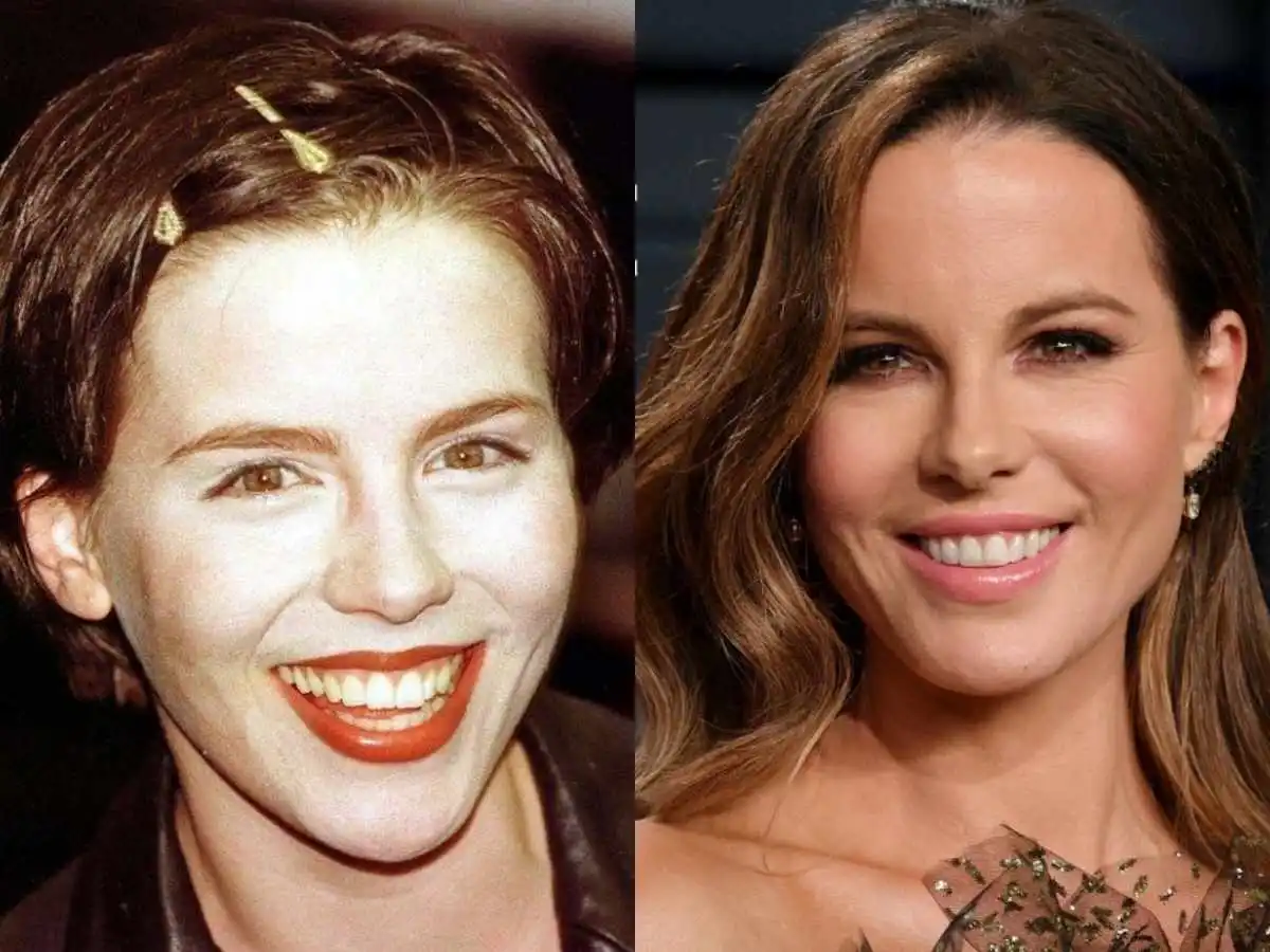 kate beckinsale teeth before after