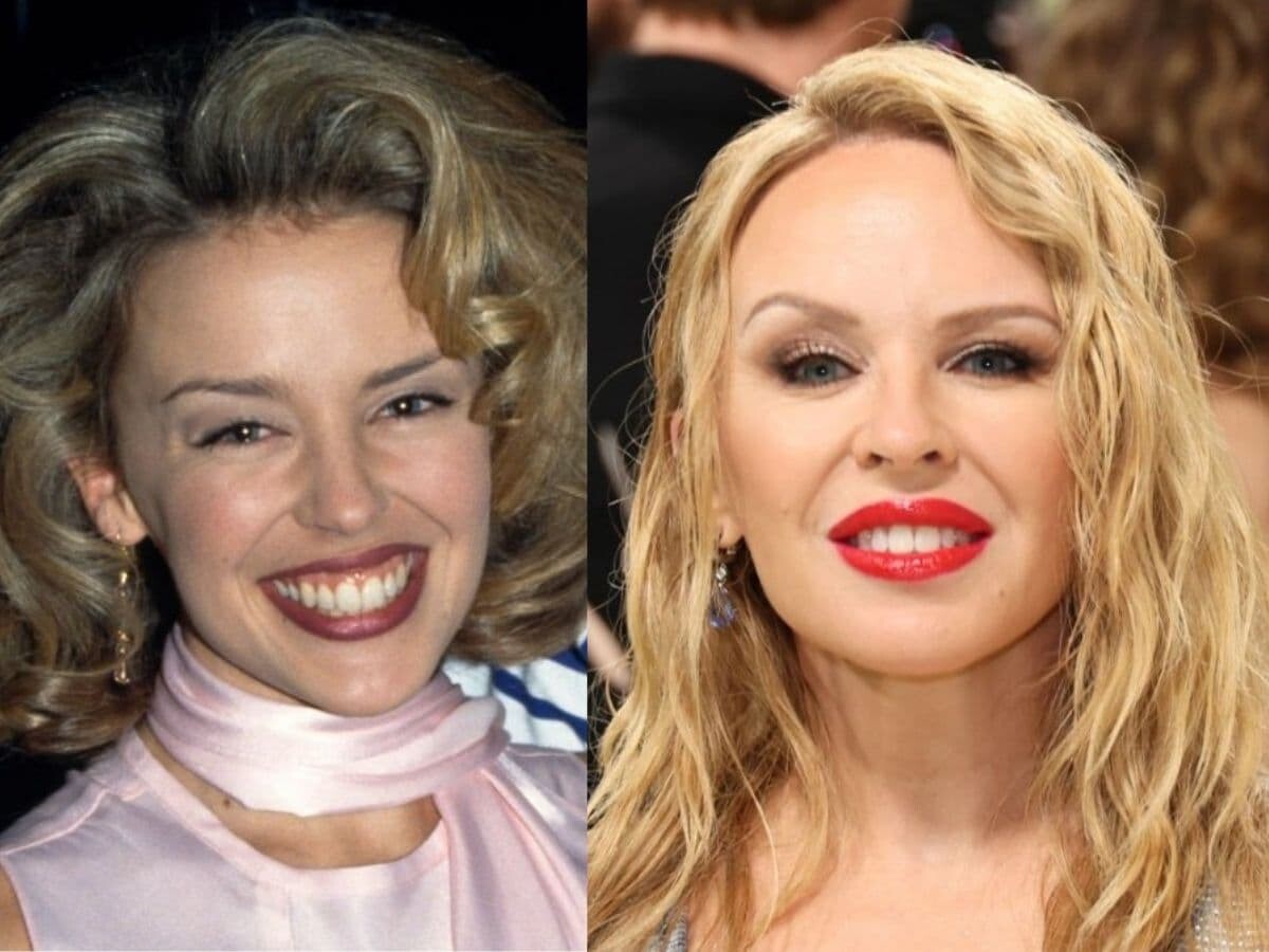 kylie minogue teeth before after