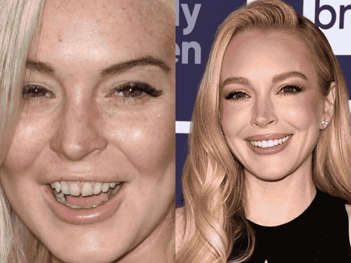lindsay lohan teeth before after