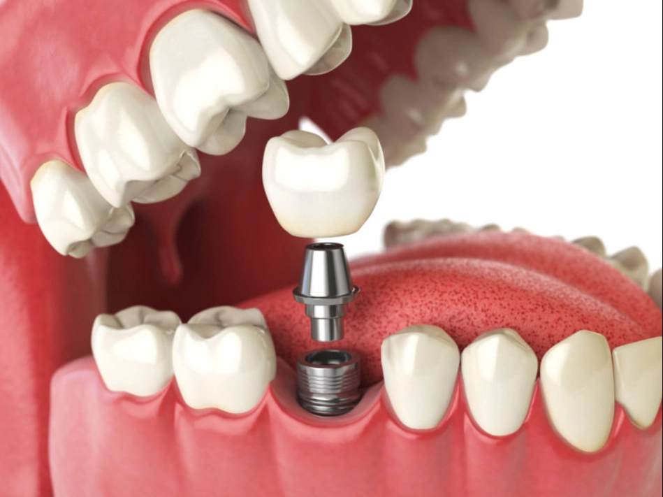 How Do Dental Implants Work