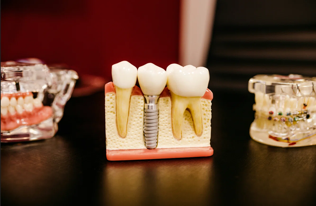 How Much Do Dental Implants Cost