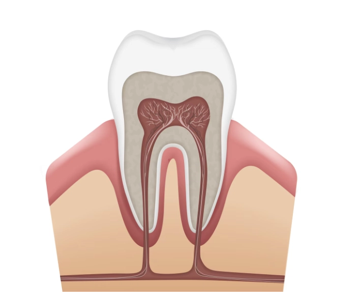 Root Canal