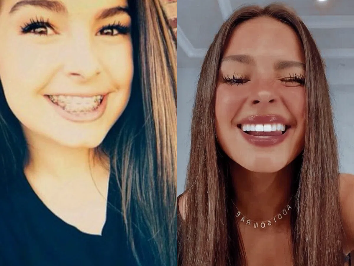 addison rae teeth before after