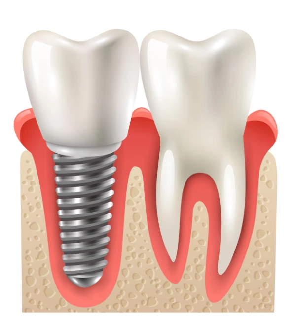 are Straumann dental implants dental products strong safe