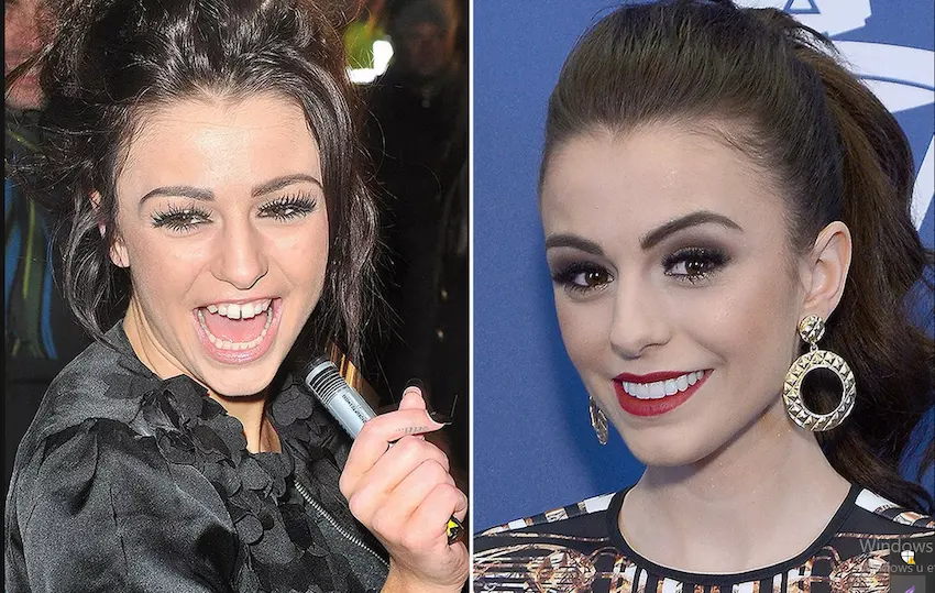 cher lloyd teeth before after