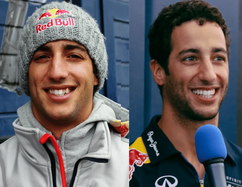 daniel ricciardo teeth before after