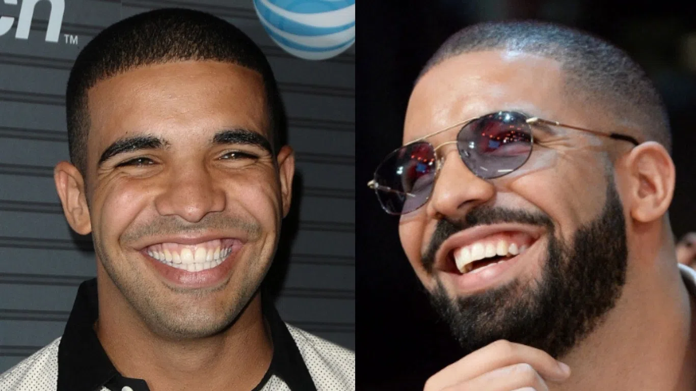 drake teeth before after