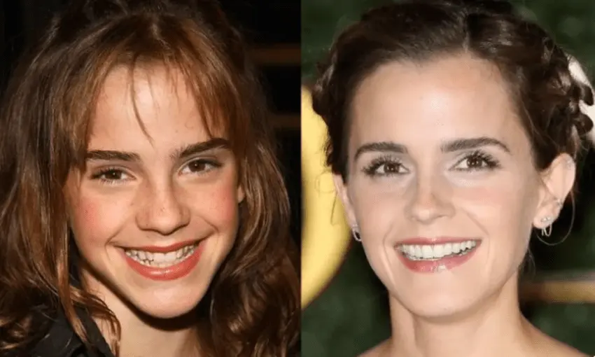 Emma Watson's teeth before after