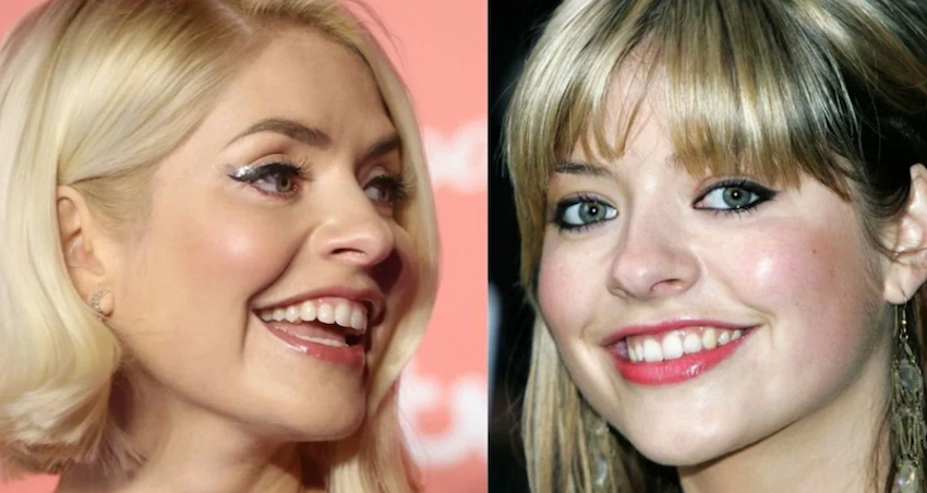 holly willoughby teeth before after