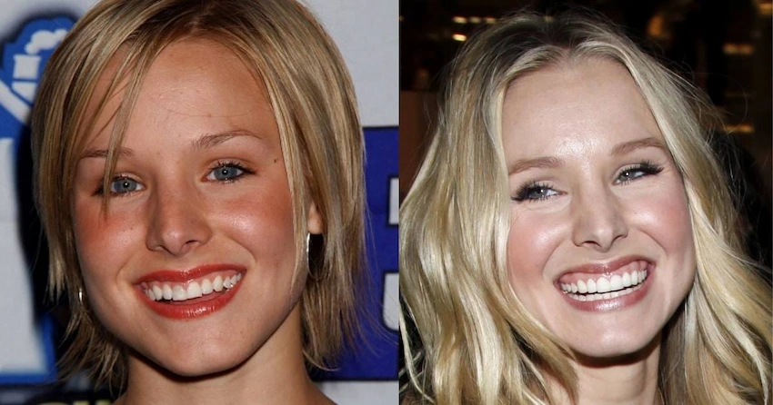 kristen bell teeth before after
