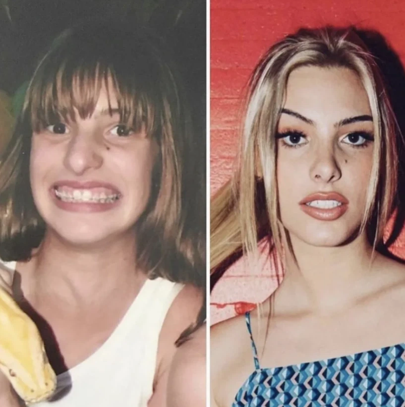 lele pons teeth before after