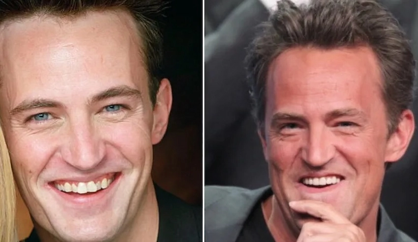 matthew perry teeth
