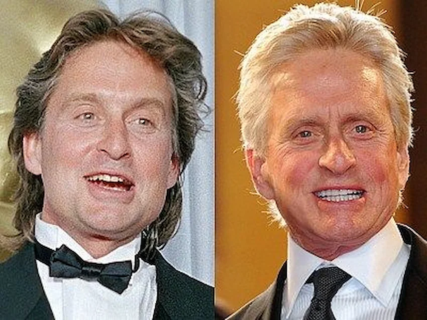 michael douglas teeth before after