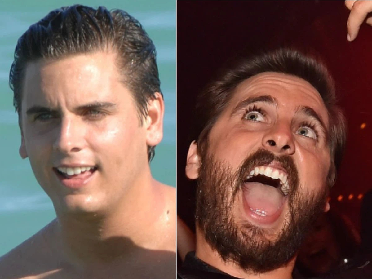 scott disick teeth before after