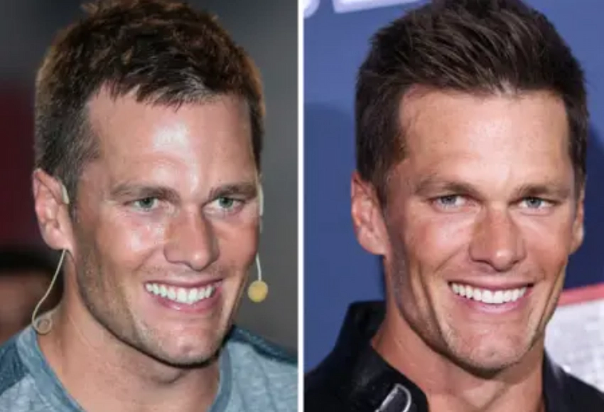 tom brady teeth before after
