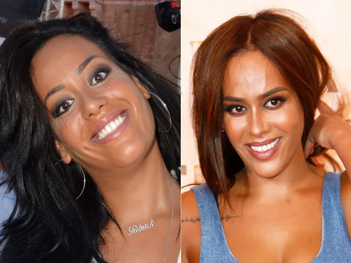 amel bent teeth before after