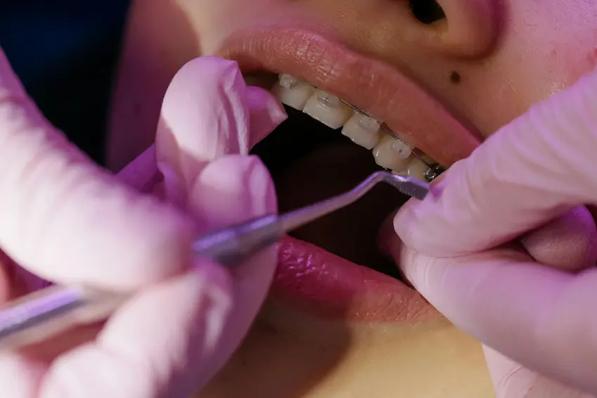 braces blog