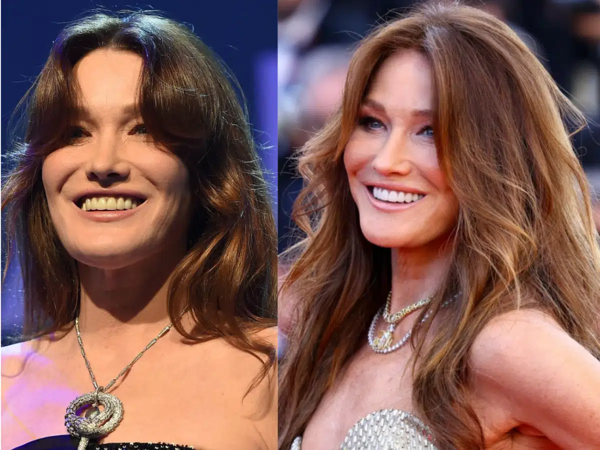 carla bruni sarkozy teeth before after