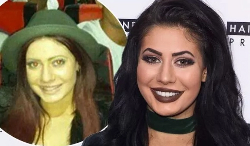 chloe ferry teeth