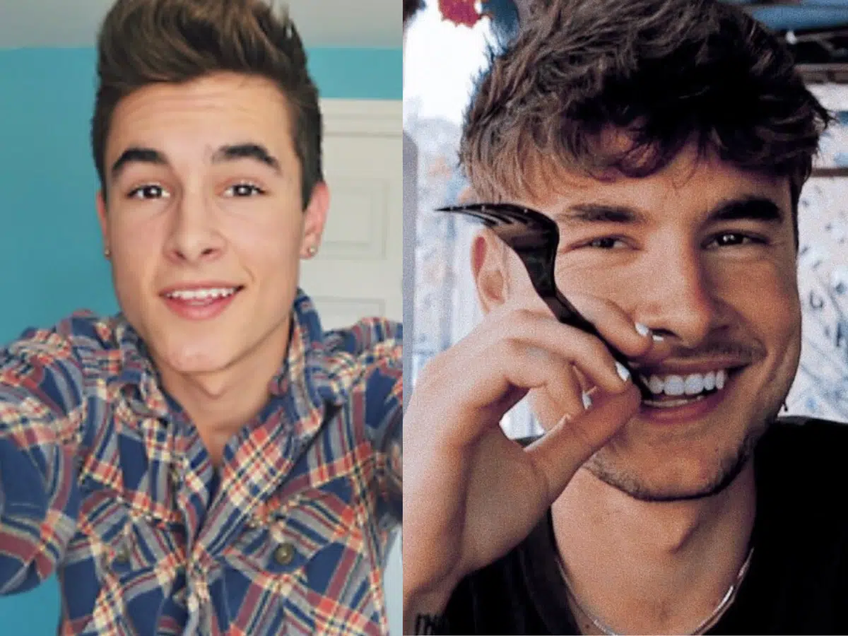 kian lawley teeth before after