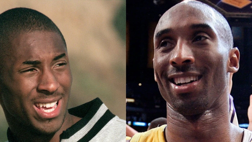 kobe bryant teeth before after