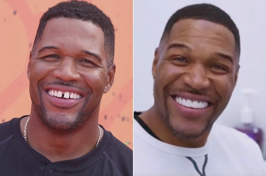 michael strahan teeth before after