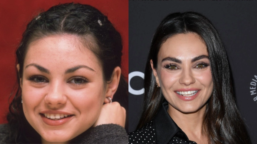 mila kunis teeth before after
