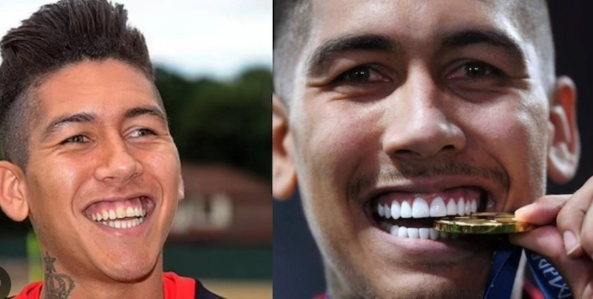 roberto firmino teeth