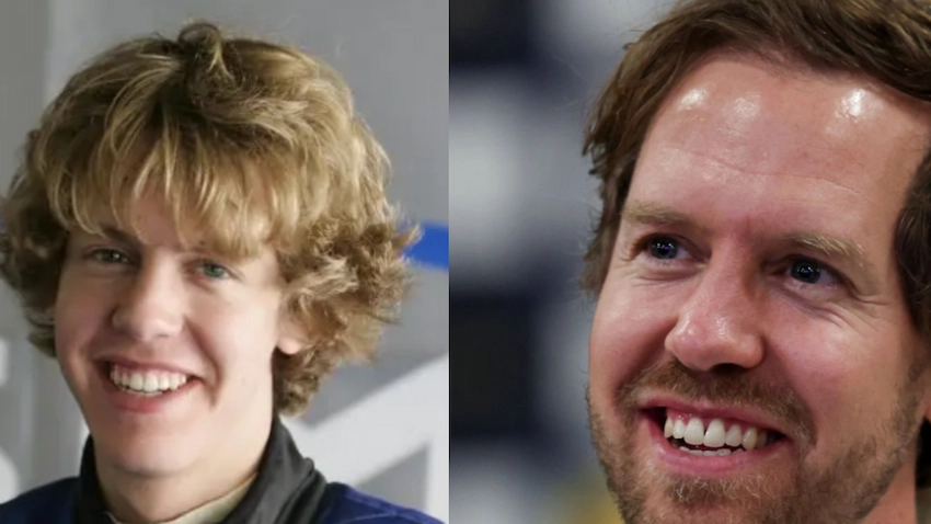 sebastian vettel teeth before after