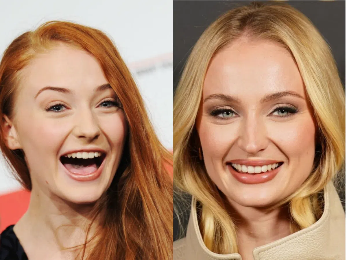 sophie turner teeth before after