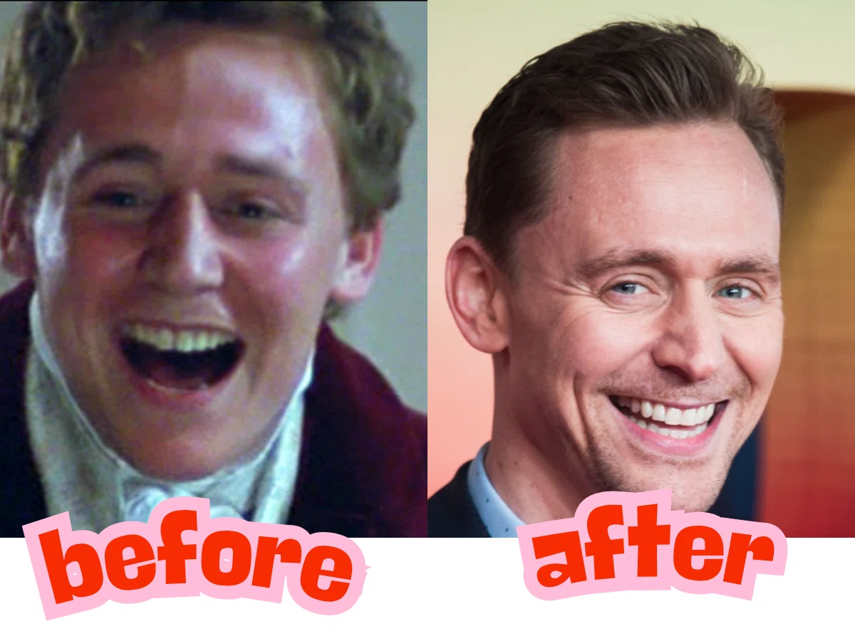tom hiddleston teeth before after
