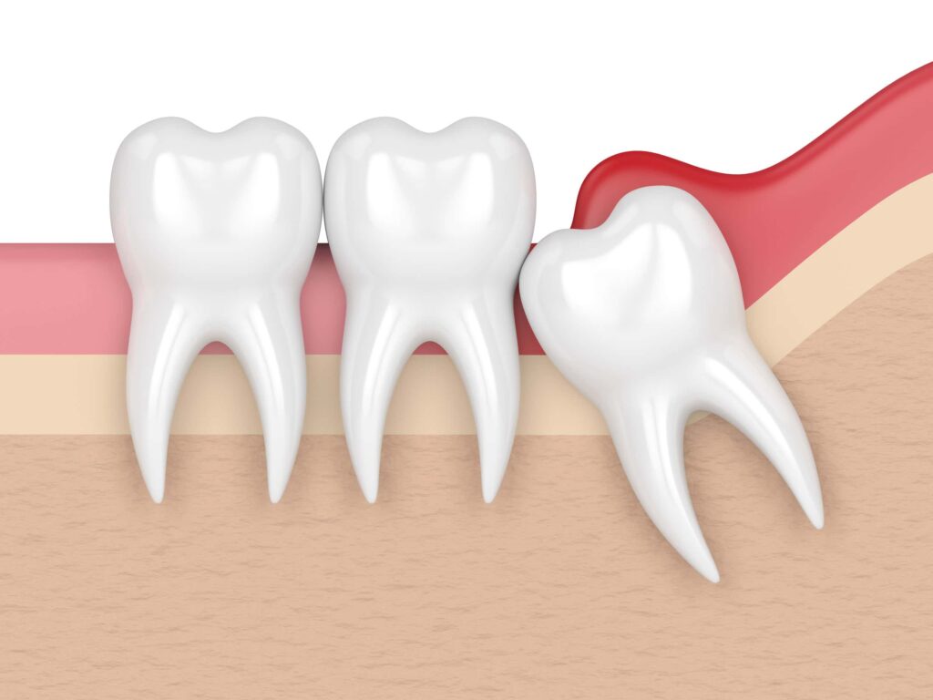 Common Wisdom Teeth Symptoms