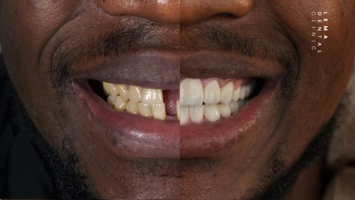 Hollywood Smile in Turkey cost