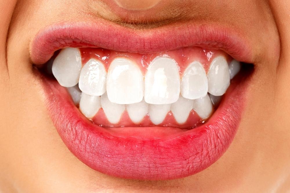 Bruxism