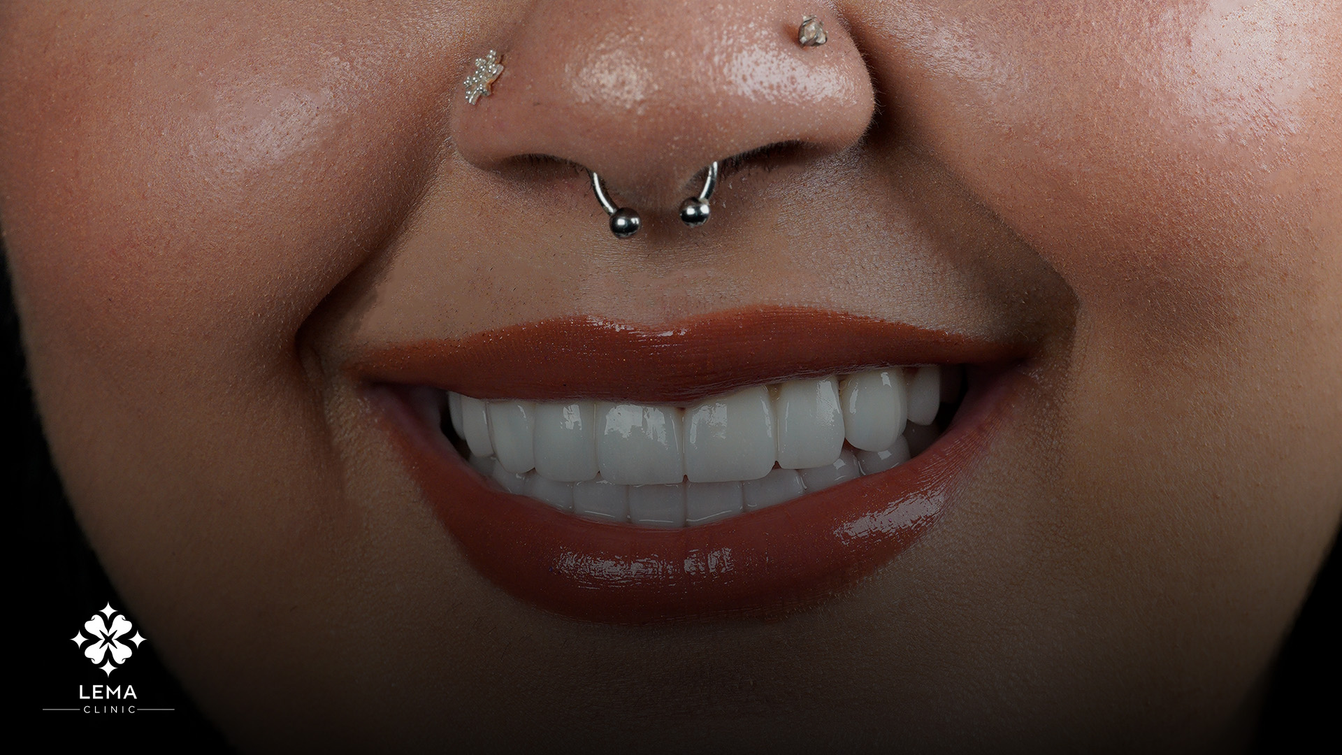 Cuidado Posterior A Los Implantes Dentales