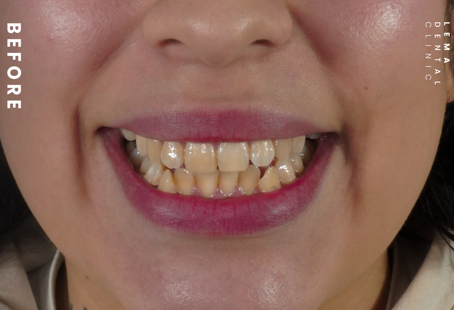 Hollywood Smile Before And After