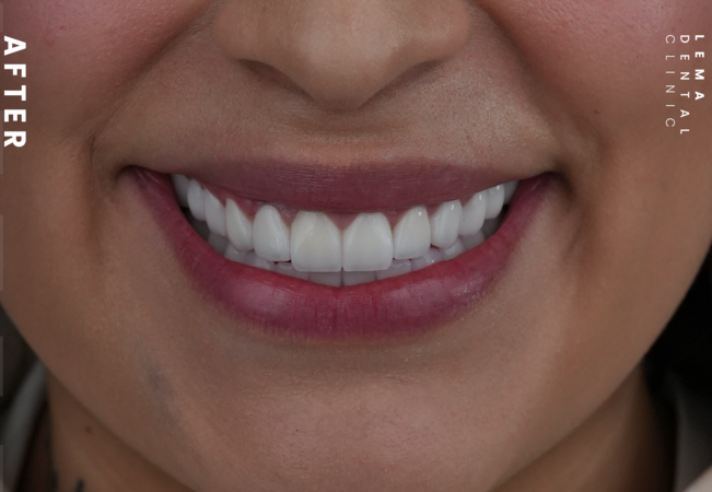 Hollywood Smile Before And After