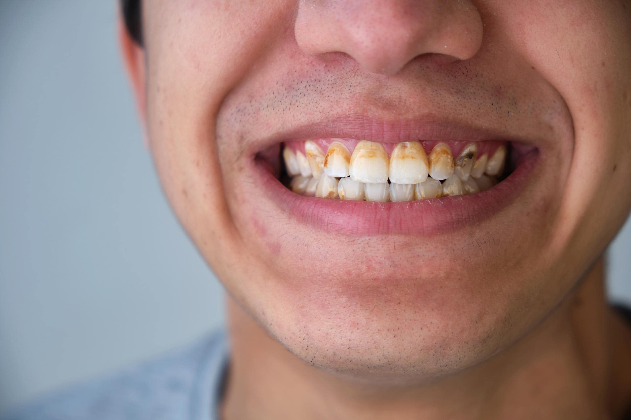 How To Remove Tartar From Teeth At Home