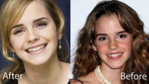 Emma Watson davanti ai suoi denti