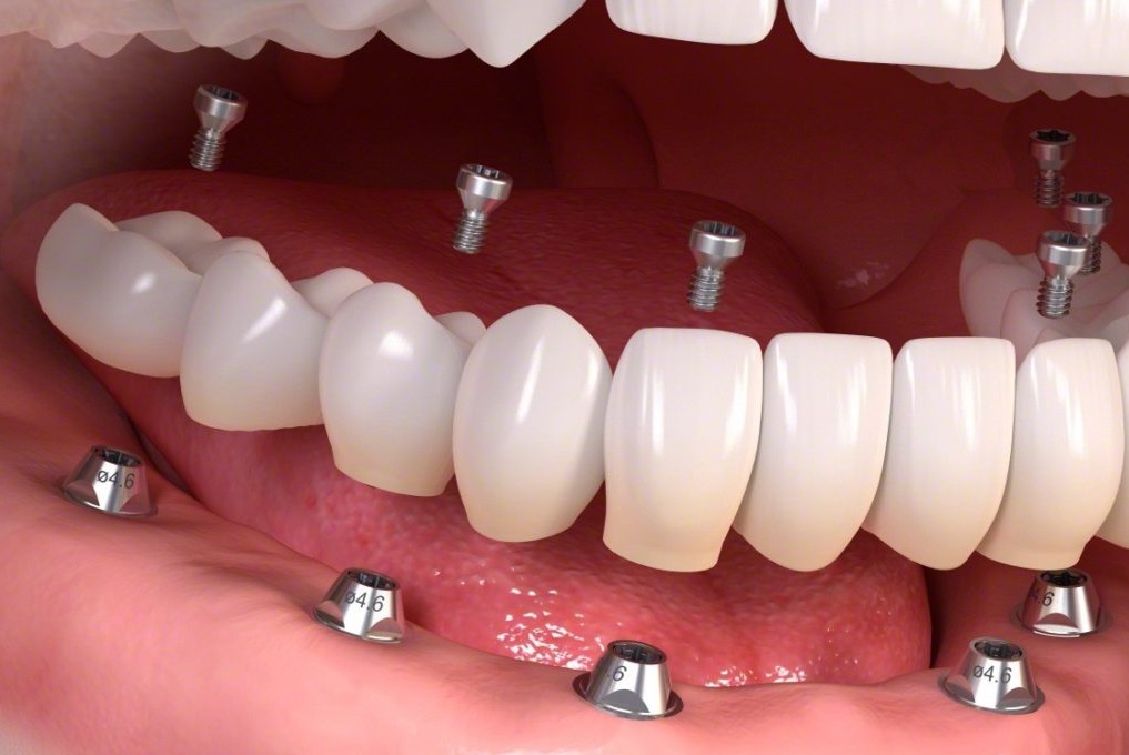 dental-implant