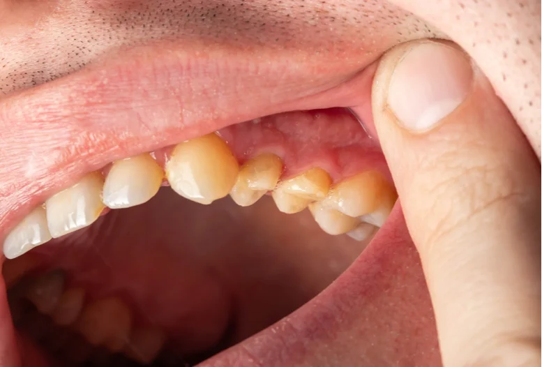 dentine apparente que faire